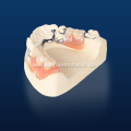 Removable Denture Metal Partial Vatalium Frame